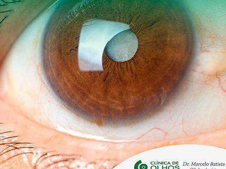 Mitos e verdades sobre a catarata