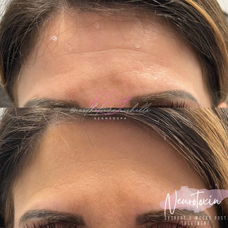 Dysport S2G Medical Spa West Bloomfield MI