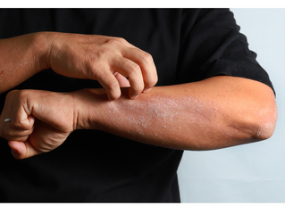 Eczema Unmasked: Understanding, Managing, and Living with Eczema