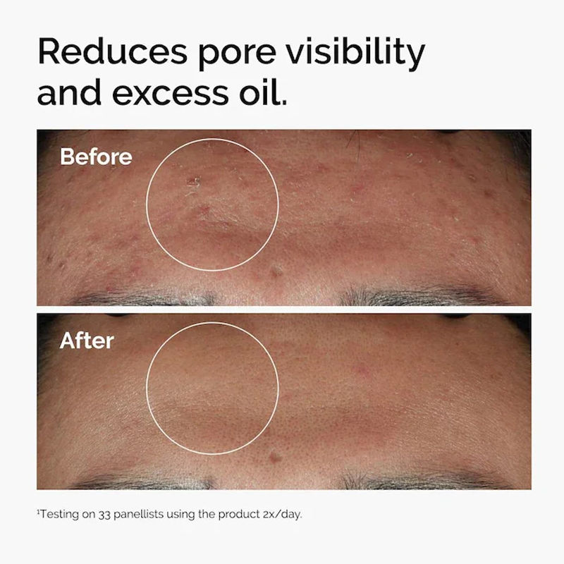 Thumbnail: Niacinamide 10% + Zinc 1% Serum 30ml A Universal Essence Suitable for Acne-prone