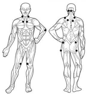 Fibromialgia e MTC