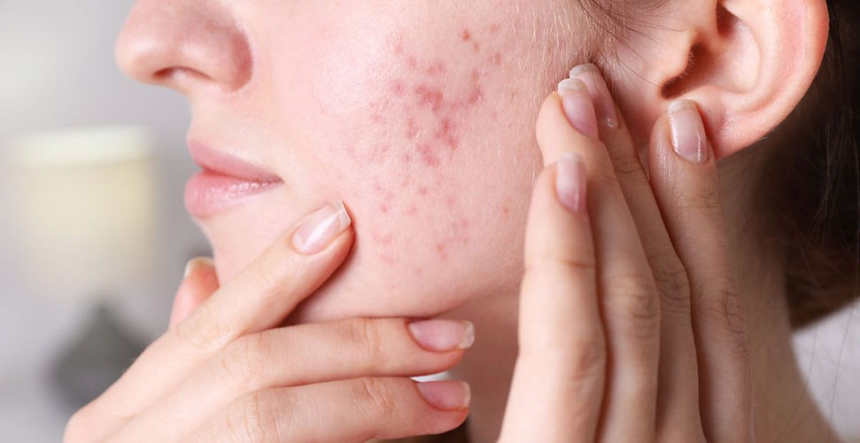 hormonal-acne-1200x618.jpg
