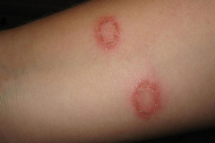 TINEA-CORPORIS-RINGWORM-OF-THE-BODY-1170x780.jpg