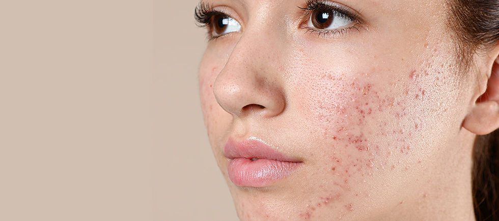 Best_Cures_For_Pimples_And_Oily_Skin_featured_image_reequil.jpg_v=1652787200.jpg