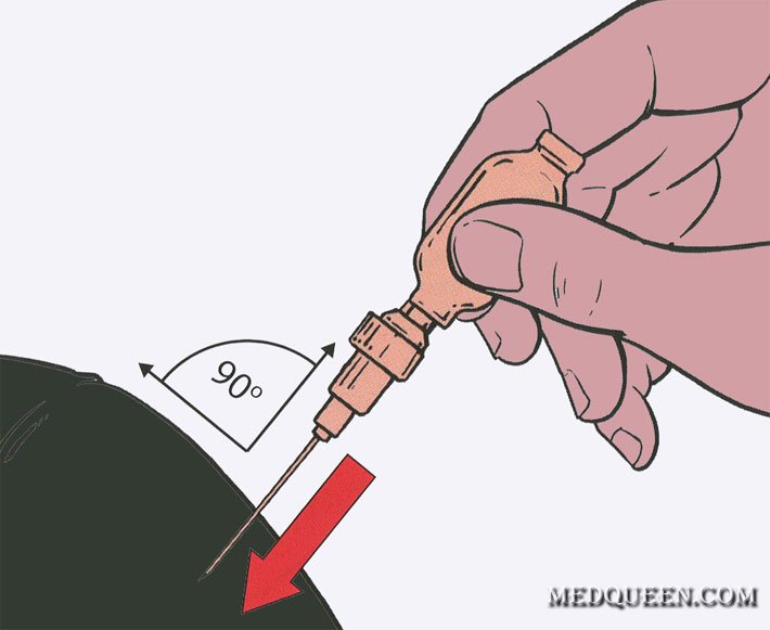 Нефопам Шприц Тюбик Купить В Ростове