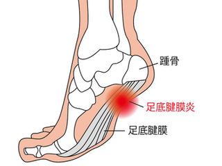 足のお疲れと足底腱膜炎予防