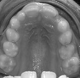 Invisalign, Ortodonzia linguale, ortodonzia funzionale, Santarcagelo, Ferrara, Rimini, Bologna, Funo, Ortodonzia