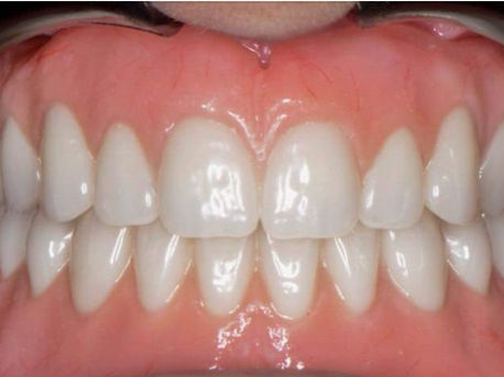 Cutback Zirconia Layered Crowns