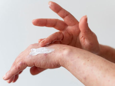 Alergia a nÃquel: Aprenda a tratar!