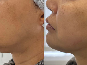 Understanding HIFU: Is This Non-Surgical Treatment Right for You in Birmingham?