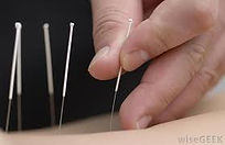 Acupuncture Clinic in Burlington, Essex VT