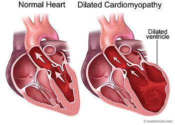 Cardiomyopathy.jpg