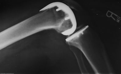 Lexington, 40509, BBN Physical Therapy, Knee