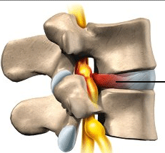 Herniated disc, physical therapy lexington, 40509, neck pain