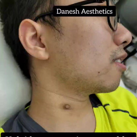 Keloid acne scar is treatable! 