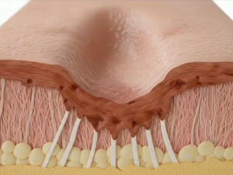 Is combining Subcision with other modalities better?