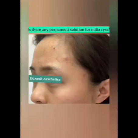 The Balanced Approach to Smoother SkinHeadline: Why I don’t rely on aggressive tools for milia removal