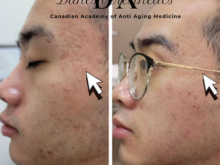 Dear All,Sometimes acne scars or other form of scars could turn to deep indentation.