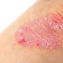 psoriase.jpg