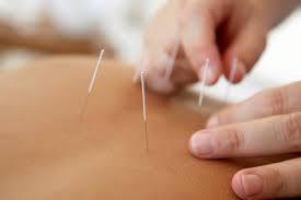 Acupuntura