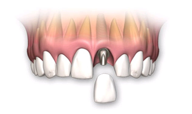 Dental Implant & Teeth Whitening Clinic in Miami, FL