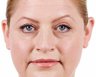 Anti Wrinkle Injections