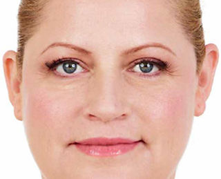 Anti Wrinkle Injections