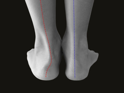 30 Seconds of Therapy: Pronation Syndrome: A Movement-Based Rehab Guide