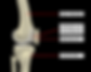 Patellofemoral pain syndrome (PFPS), also known as runner's knee, is a condition characterized by pain in the front of the knee, specifically around the kneecap (patella). The pain is often described as a dull ache and may worsen with activities that load the knee, such as bending, climbing stairs, squatting, or prolonged sitting.
