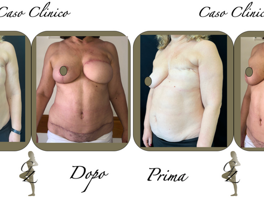 La ricostruzione autologa con lembo DIEP