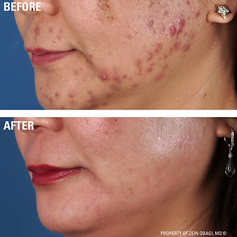 ZO Skin Health Acne Regime Results