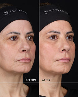 Skin Quality RHA 1 and Redenstiy 1 - Before & After-1