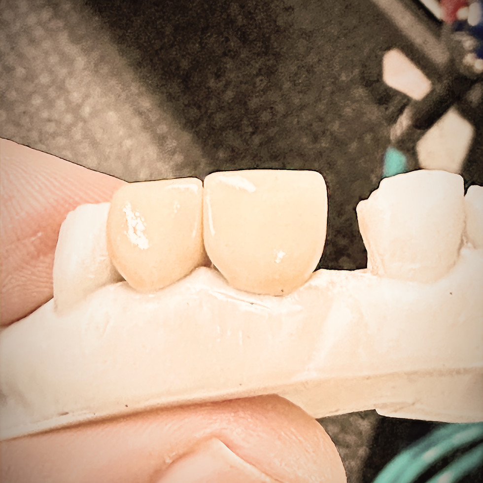 Dental bridge with two crowns, held up by a person's fingers.