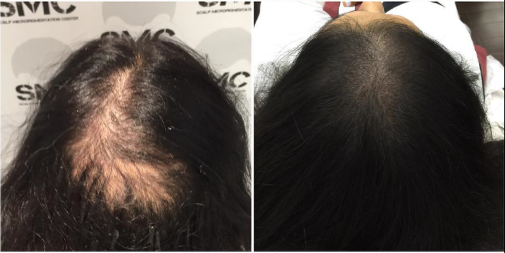 Scalp Micropigmentation Will Be Available At All Hair Transplant
