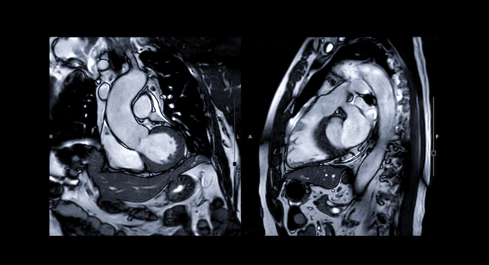 MRI is rapidly advancing with artificial intelligence tools that further refine risk classification and prediction, potentially before any symptoms or routine blood markers are abnormal.