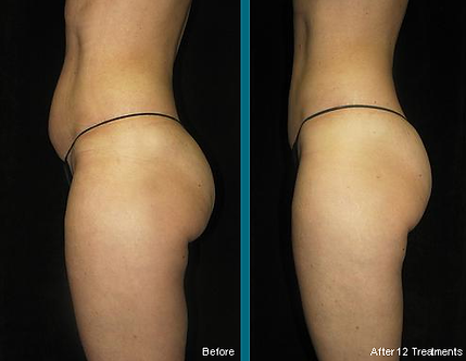 red light body contouring stomach and leg lipomelt.png