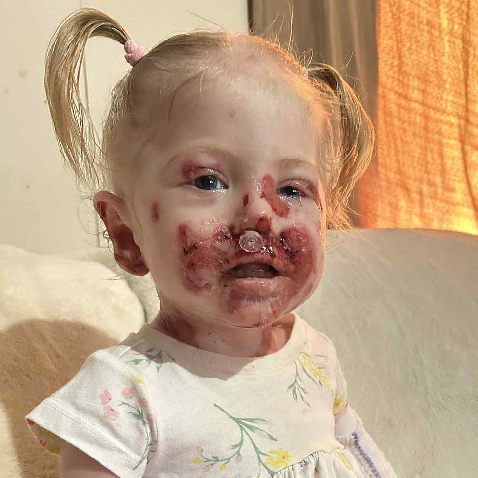 Tova Larsen is a 2-year-old with Junctional Epidermolysis Bullosa. She lives with her family in Saskatchewan, Canada.