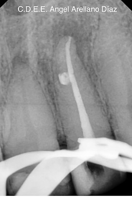Endodoncia