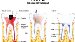Root Canal Symptoms: 7 Signs and Symptoms You Need To Know
