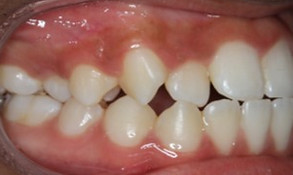 Before InvisalignTreatment: Anterior crossbite, Posterior crossbite, and crowding