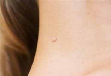 Cryofreeze Skin Tag Removal