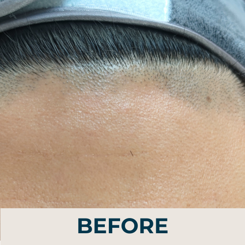 Laser hair removal waddington, Lincoln (2)