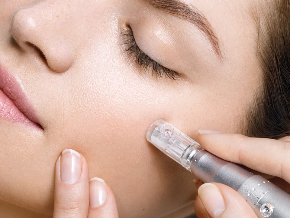 microneedling1.webp