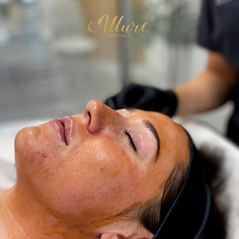 Acne_Allure_Aesthetics_Blackwood_SouthWales.png