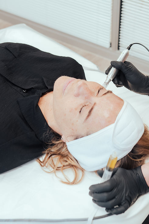 DERMA FNS MICRONEEDLING BLACKWOOD SOUTH WALES ALLURE AESTHETICS.jpg