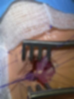 Thumbnail: Anorectal malformation (PSARP)