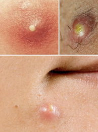 CYSTIC ACNE