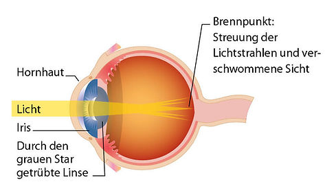 Abbildung Auge mit grauem Star