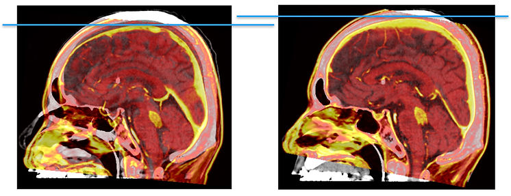 頭部CTとMRI