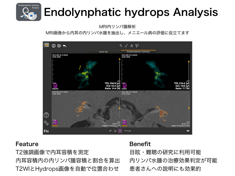 Endolynphatic hydrops Analysis